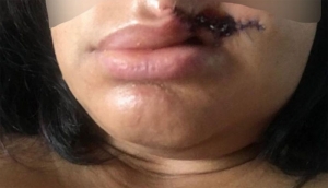 GoRiau Saat Kunjungi Acara Karnaval, Wanita Ini Kaget Bibirnya Digigit Pria Hingga Robek