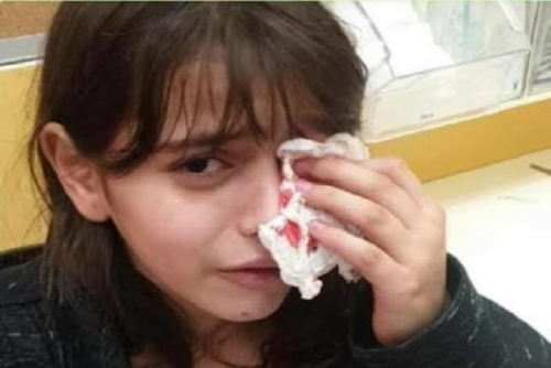 Diserang Pemukim Yahudi Saat Bermain, Gadis Kecil Palestina Luka Parah, Matanya Berdarah