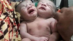 GoRiau 2 Hari Setelah Dilahirkan, Begini Kondisi Bayi Perempuan Berkepala 2 di Gresik