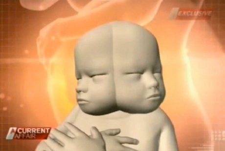 Bayinya Miliki 2 Wajah, Ibu Ini Tetap Pertahankan Kandungannya