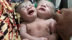 GoRiau Warga Digemparkan Kelahiran Bayi Berkepala 2, Ini Fotonya