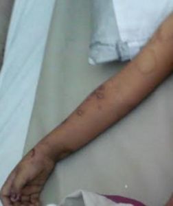 GoRiau Astaga, Balita Ini Disetrika dan Diinjak Ibu Tirinya