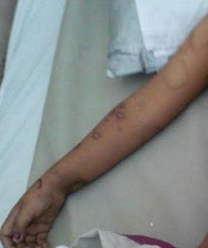 Astaga, Balita Ini Disetrika dan Diinjak Ibu Tirinya