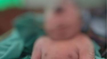 Bayi Bermata Satu Lahir di Mandailing Natal, Kasus ke-7 di Dunia, Diduga Ini Penyebabnya