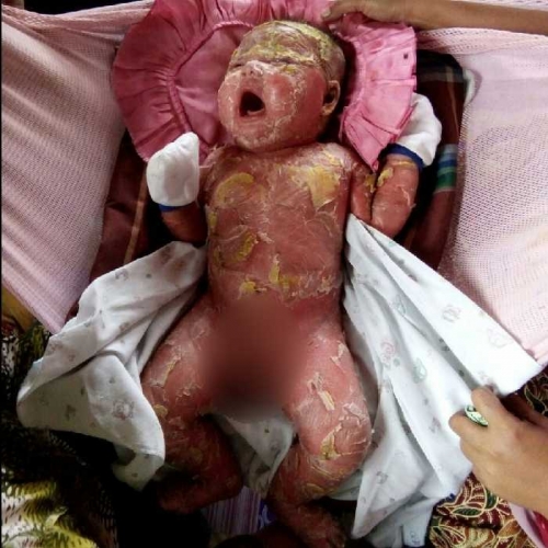 Kisah Memilukan Bayi di Riau Bernama Hafizi, Kulitnya Mengelupas dan Pecah-pecah dari Wajah Hingga Kaki