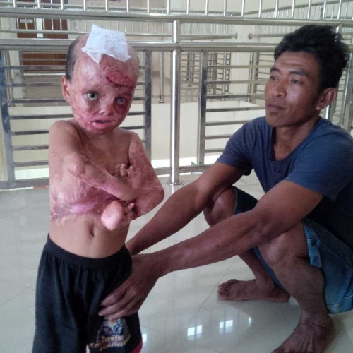 Kisah Reza, Bocah Kecil yang Melawan Maut Pasca Tubuhnya Terbakar 6 Bulan Lalu