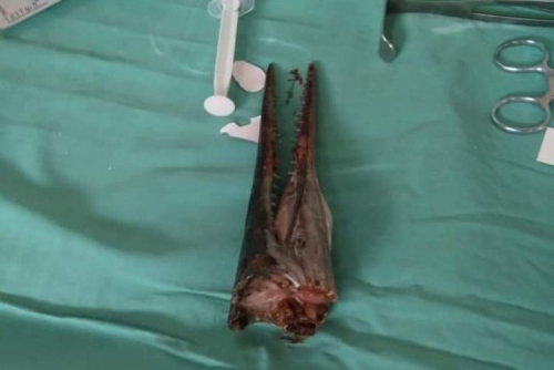 Memancing di Laut, Leher Siswa SMP Tertusuk Moncong Ikan Marlin Sedalam 14 Cm, Butuh Waktu 2 Hari Melepaskan