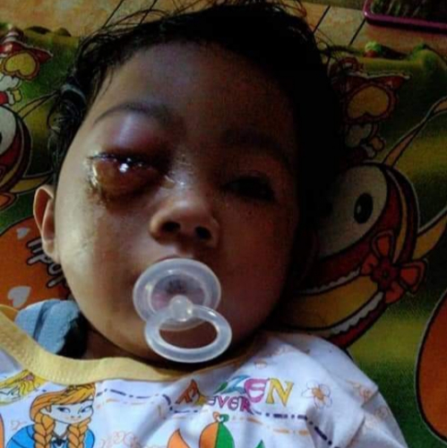 Bocah yang Menderita Infeksi Kornea Mata Akhirnya Dirujuk ke Pekanbaru