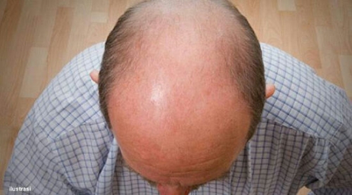 Obat Rematik Bisa Menumbuhkan Rambut Pasien Kebotakan Hingga 50 Persen