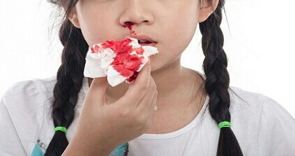 Waspadalah Bila Anak Anda Mimisan, Mungkin Saja Indikasi 5 Penyakit Berbahaya Ini