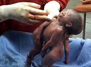 GoRiau Kasus Langka, Bayi Kembar Siam Ini Hanya Miliki Satu Wajah