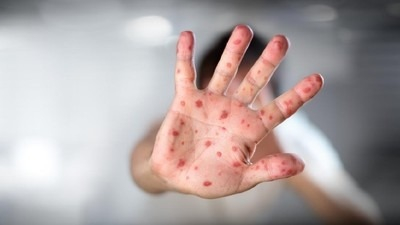 Kasus Campak Naik, Dinkes Riau dan Pemko Pekanbaru Genjot Imunisasi Anak