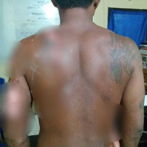 Tak Punya Duit Traktir Minum Tuak, Pria di Inhu Digebuki dan Disiram Air Panas Hingga Melepuh