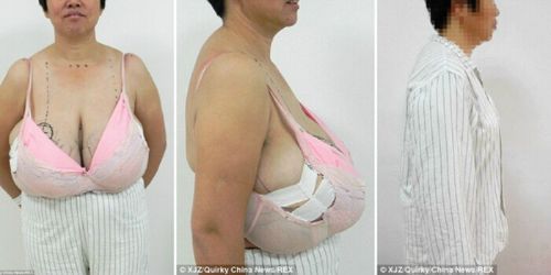 Derita Gigantomastia, Payudara Wanita Ini Berkembang Pesat Hingga Seberat 6 Kilogram